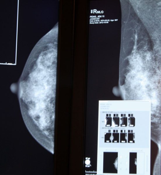 乳房磁振造影對乳癌診斷優點外部提供-552x600